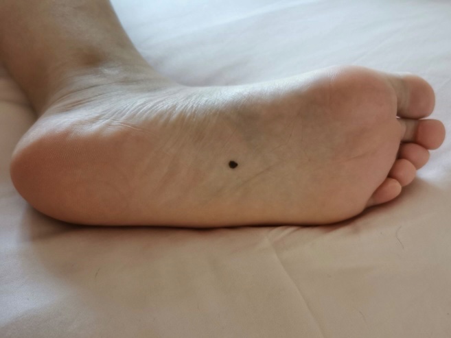 脚下有一个痣是什么意思