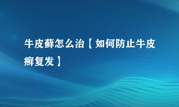 牛皮藓怎么治【如何防止牛皮癣复发】
